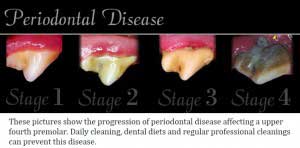 Stages of Dental Disease