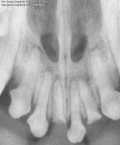 Dental Radiograph
